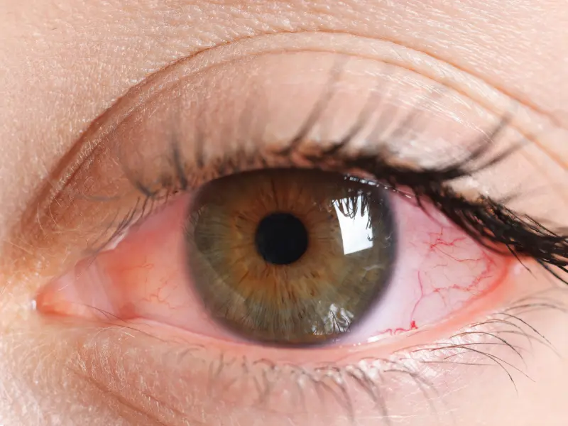 ما هو التهاب العين بعد عملية الليزك؟